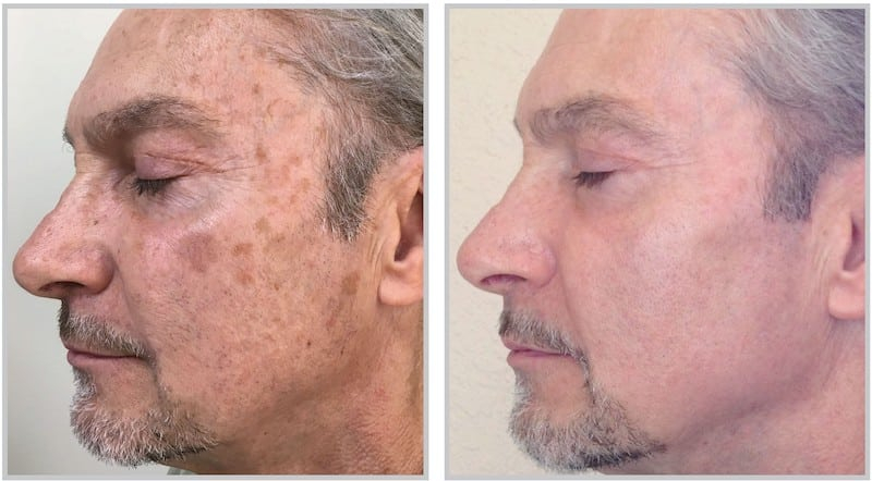 Before and After Image: Halo - left-side