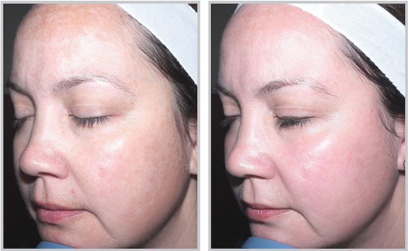Before and After Image: Halo - front
