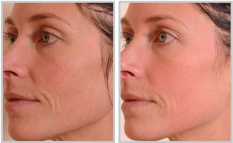 Before and After Image: Halo - left-front-oblique