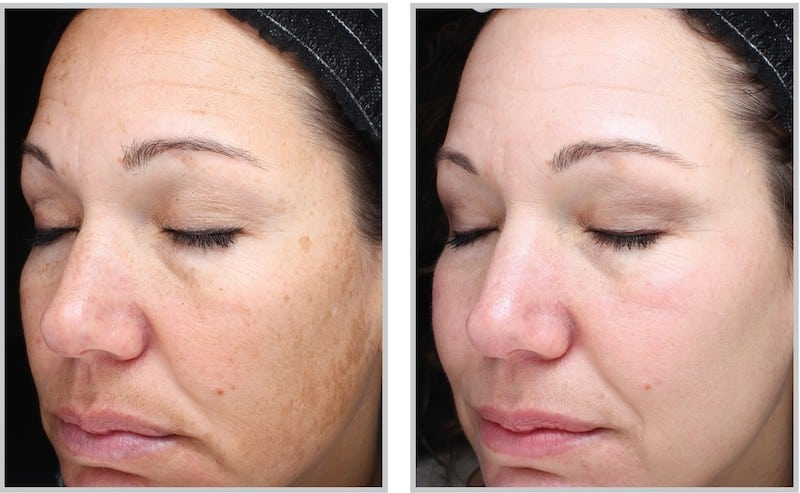 Before and After Image: Halo - front