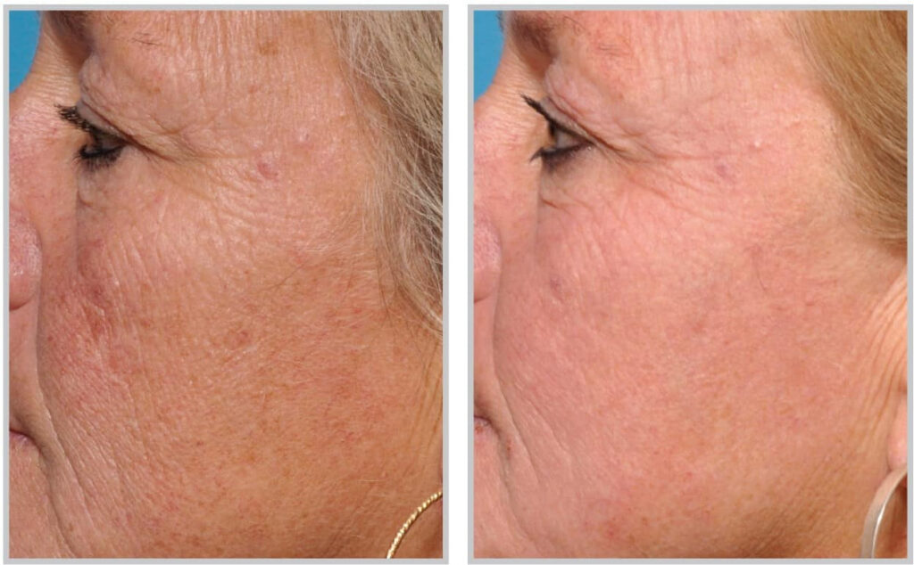 Before and After Image: Halo - left-side