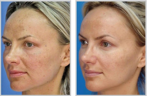Before and After Image: Laser Peel - left-front-oblique