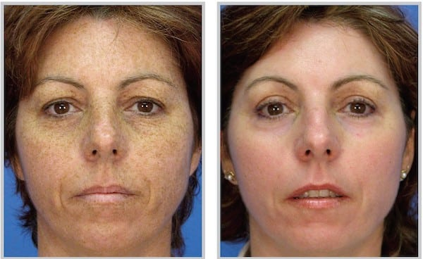 Before and After Image: Laser Peel - front
