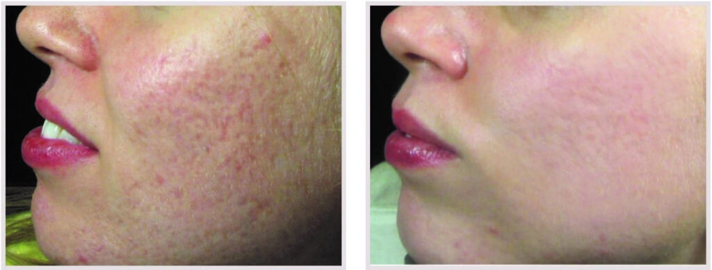 Before and After Image: Laser Peel - front