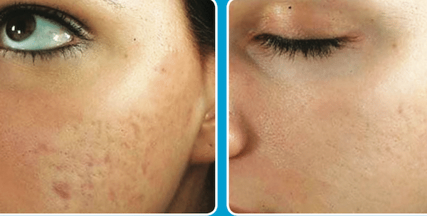 Before and After Image: Microchanneling - left-front-oblique
