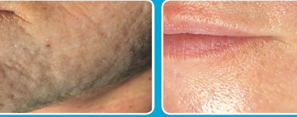 Before and After Image: Microchanneling - left-front-oblique