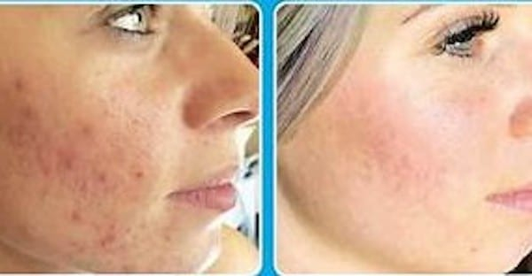 Before and After Image: Microchanneling - right-side