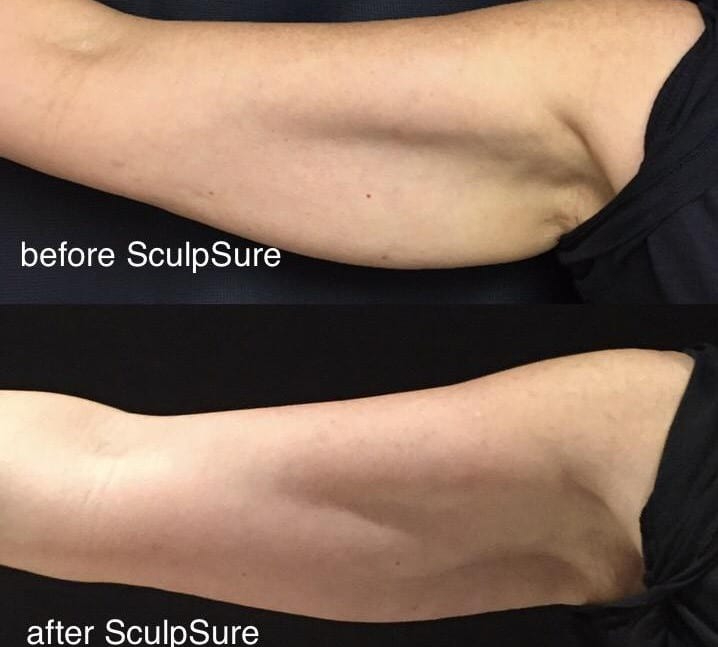 Before and After Image: SculpSure - front