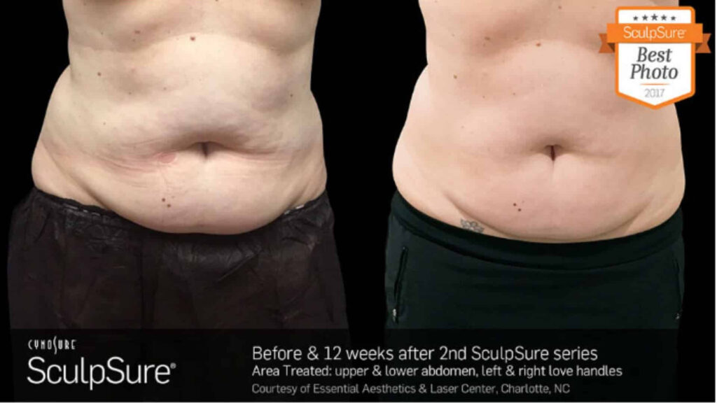 Before and After Image: SculpSure - front