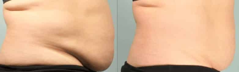 Before and After Image: SculpSure - right-side
