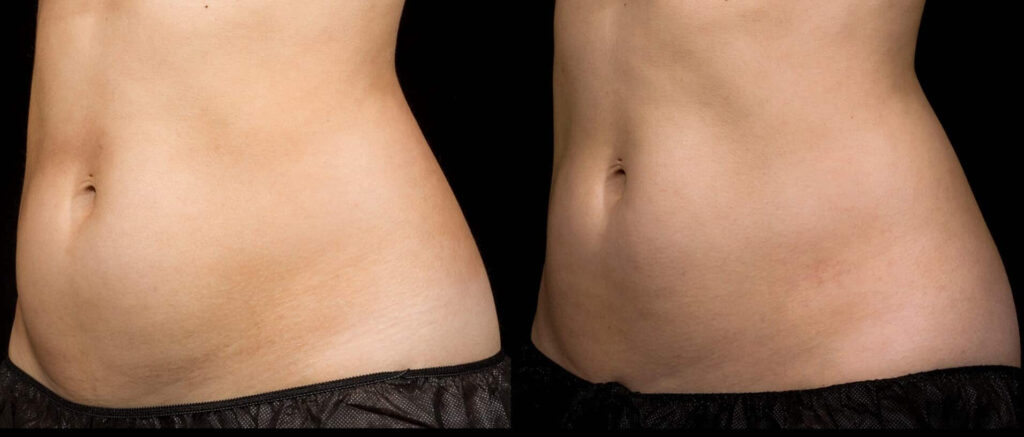 Before and After Image: SculpSure - left-front-oblique