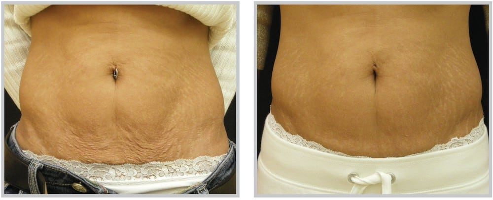 Before and After Image: SkinTyte - front