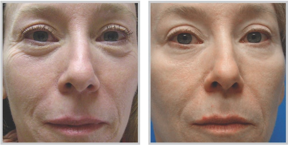 Before and After Image: SkinTyte - front