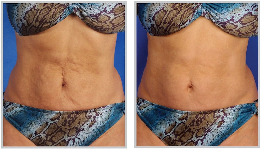 Before and After Image: SkinTyte - front