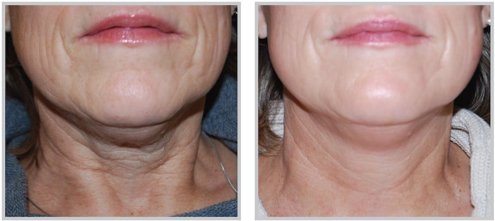 Before and After Image: SkinTyte - front