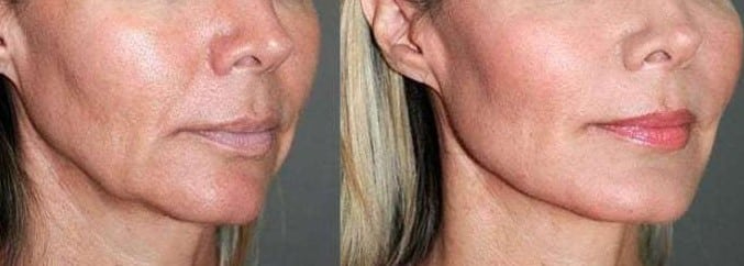 Before and After Image: Threadlift - right-front-oblique