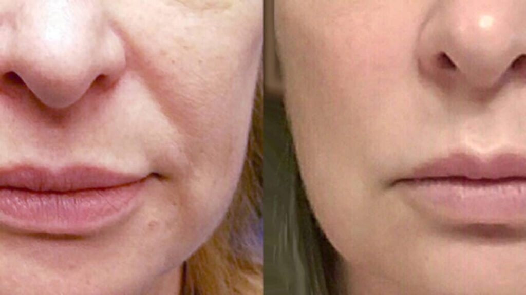 Before and After Image: Threadlift - front