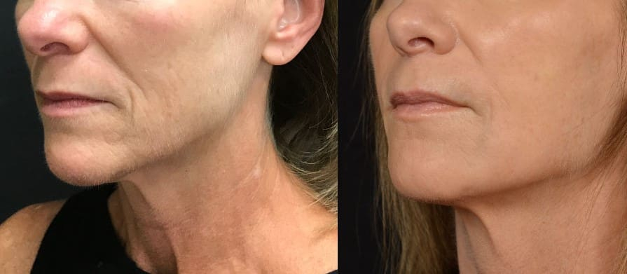 Before and After Image: Threadlift - left-front-oblique
