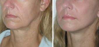 Before and After Image: Threadlift - left-front-oblique