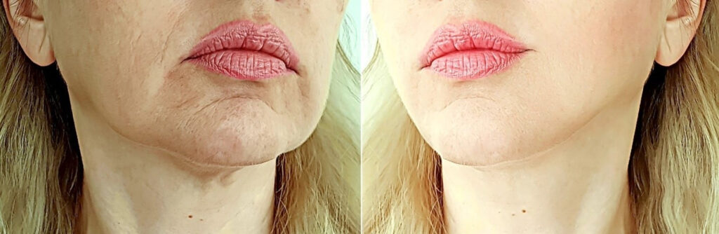 Before and After Image: Threadlift - front