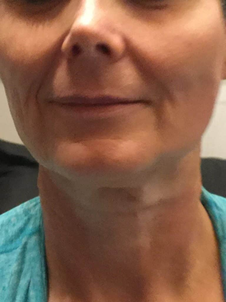 After Image: Threadlift - front