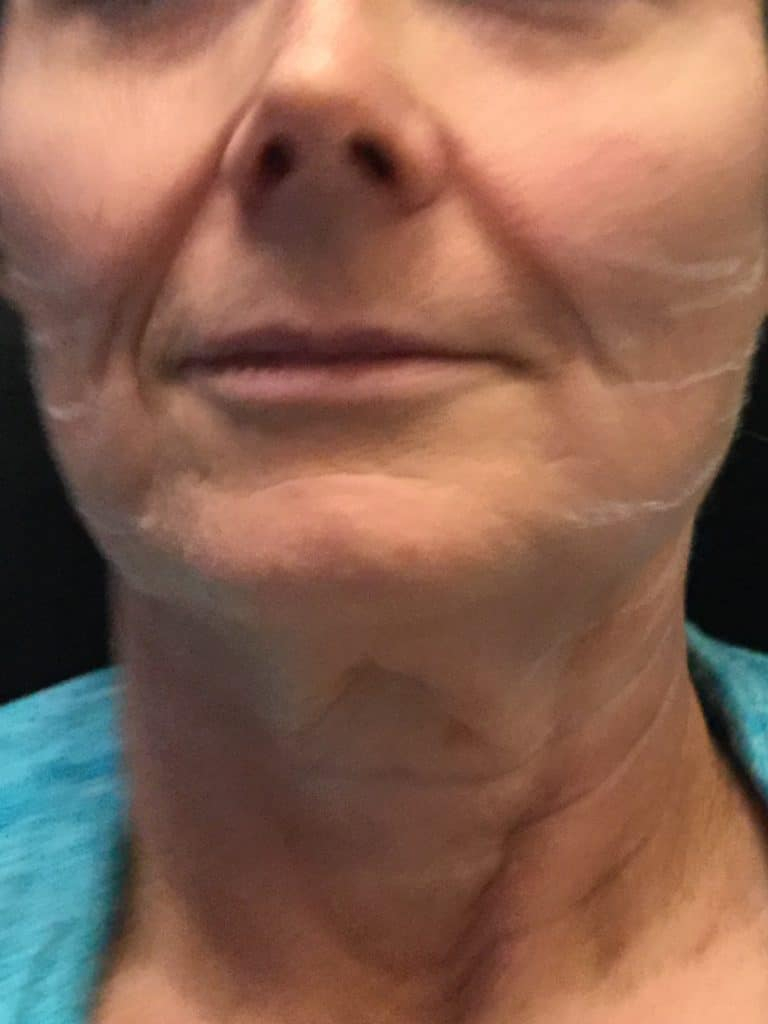 Before Image: Threadlift - front