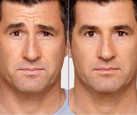 Before and After Image: Wrinkle Reducers - front