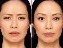 Before and After Image: Wrinkle Reducers - front