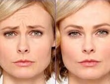 Before and After Image: Wrinkle Reducers - front