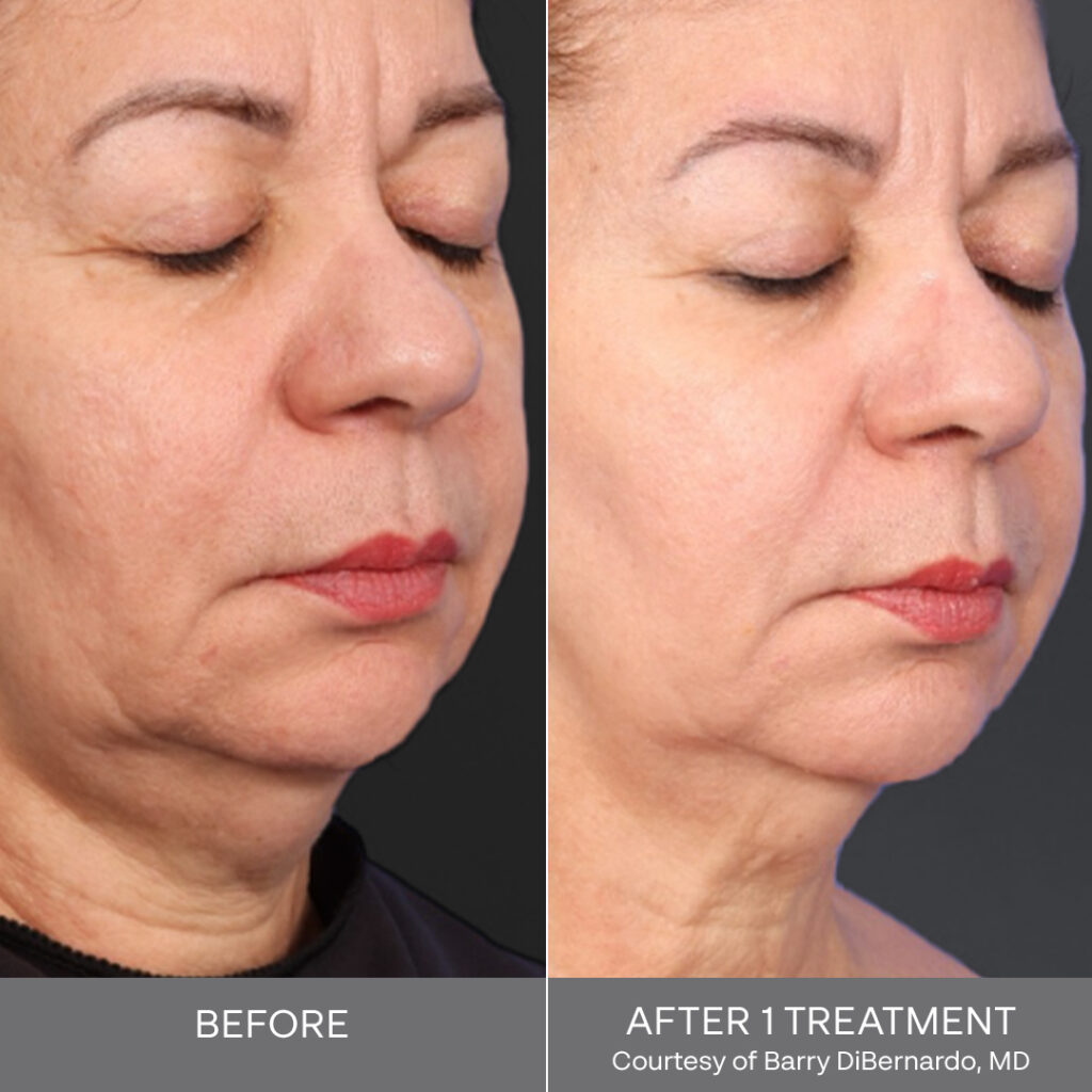 Side-by-side before-and-after clinical photos of XERF Structural Skin Tightening showing the lower face and neck of an adult woman with eyes closed. The “before” image shows visible skin laxity and fullness along the jawline and under the chin. The “after 1 treatment” image shows a more defined jawline, firmer-looking skin under the chin, and subtle tightening of the neck area