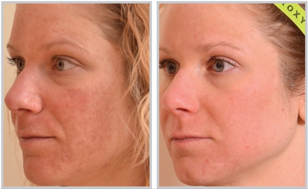 Before-and-after close-up photos of a woman’s cheek and jawline showing improved skin texture, tone, and clarity after Halo laser treatment HALO® Laser for Acne Scars