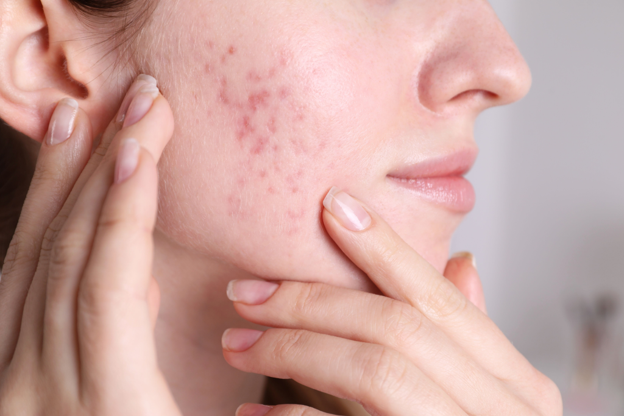 Close-up of a woman’s cheek with her hands resting on her cheek. Her cheek has several visible, red acne scars HALO® Laser for Acne Scars