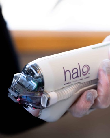 The HALO laser is pictured up close, with the purple logo visible on the side of the device and the tip of the laser illuminated and pointed toward the camera HALO® Laser for Acne Scars